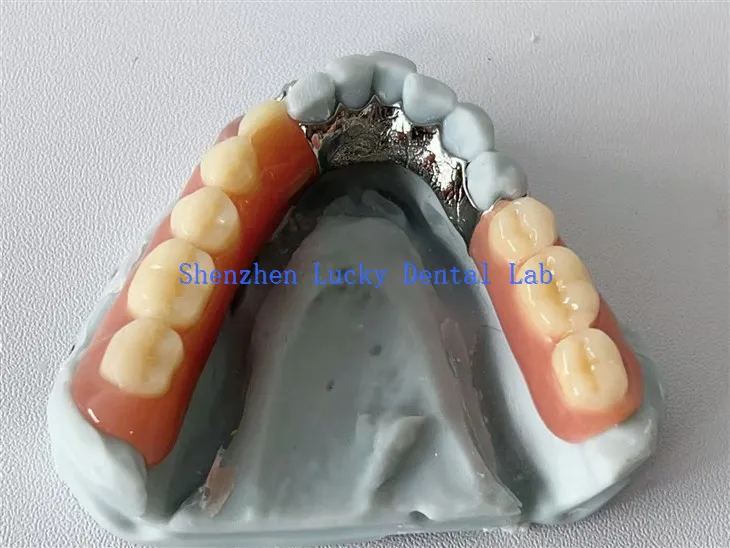 3D εκτύπωση Lingual Plate Dental Metal Framework με ακρυλική οδοντοστοιχία