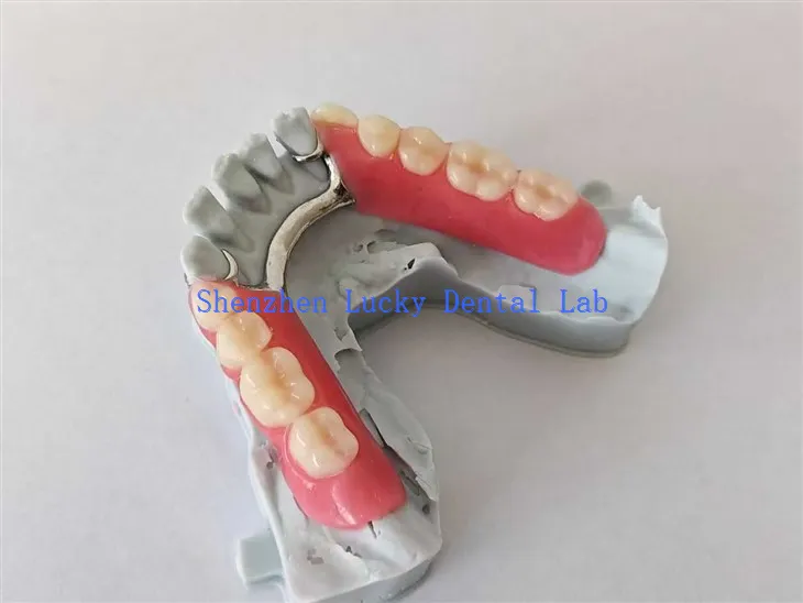 3D εκτύπωση μερική ακρυλική οδοντοστοιχία με μεταλλικό πλαίσιο δοκιμάστε στο Dental Lab