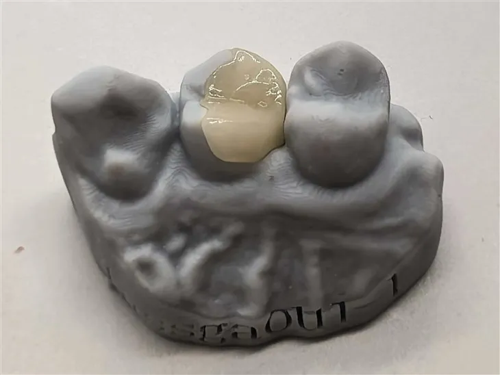 Αυθεντικό Composite Onlay για καλύτερη τιμή