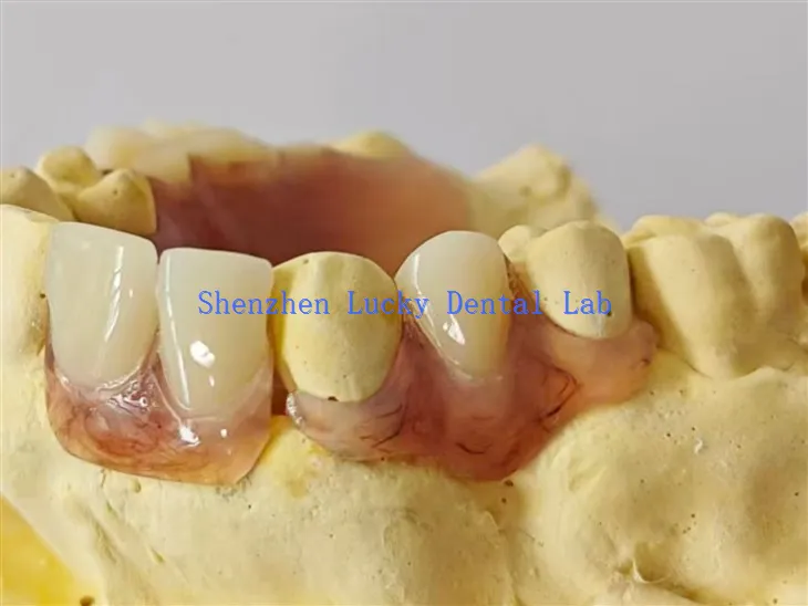 Κίνα Dark Gum Dental Metial Fexible Denture