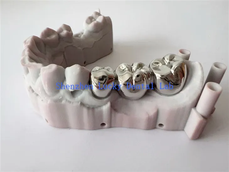 Προσαρμοσμένο οδοντικό πλήρες μεταλλικό στέμμα