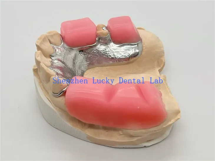 Μεταλλικό σκελετό με μπλοκ δαγκώματος