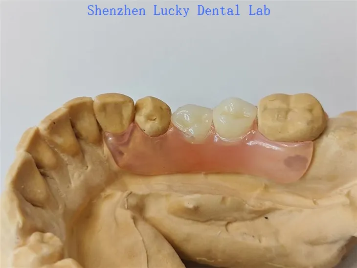 Μερική εύκαμπτη οδοντική οδοντοστοιχία με κατασκευαστές κούμπωμα Valplast