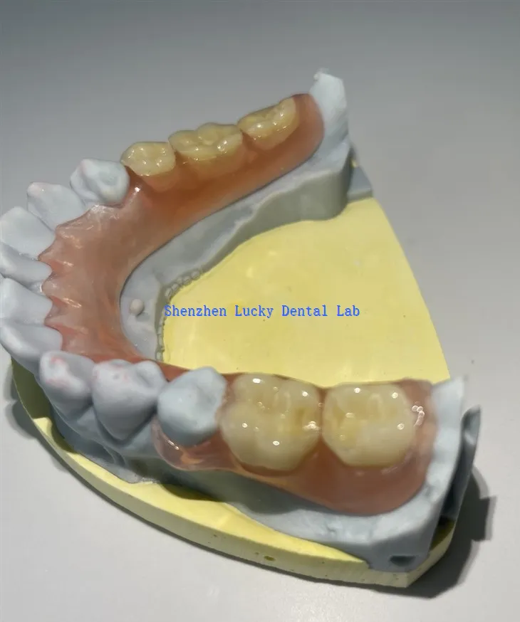 Μερική ευέλικτη οδοντοστοιχία