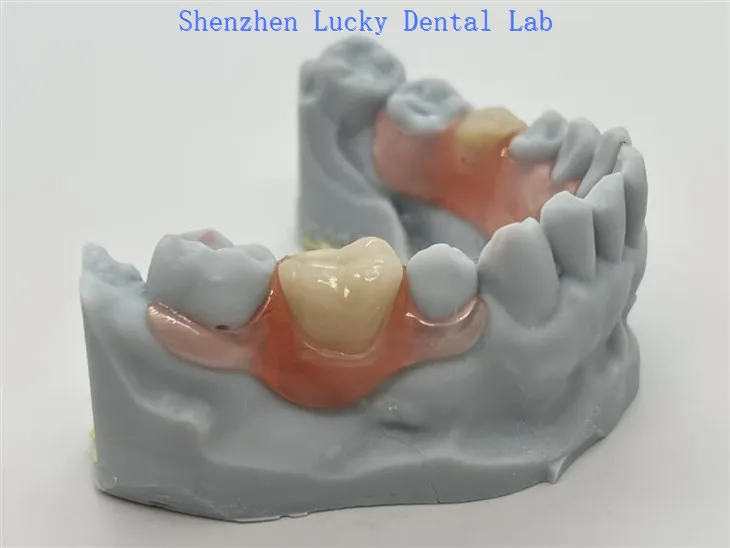 Valplast® Partials με εύκαμπτο κούμπωμα